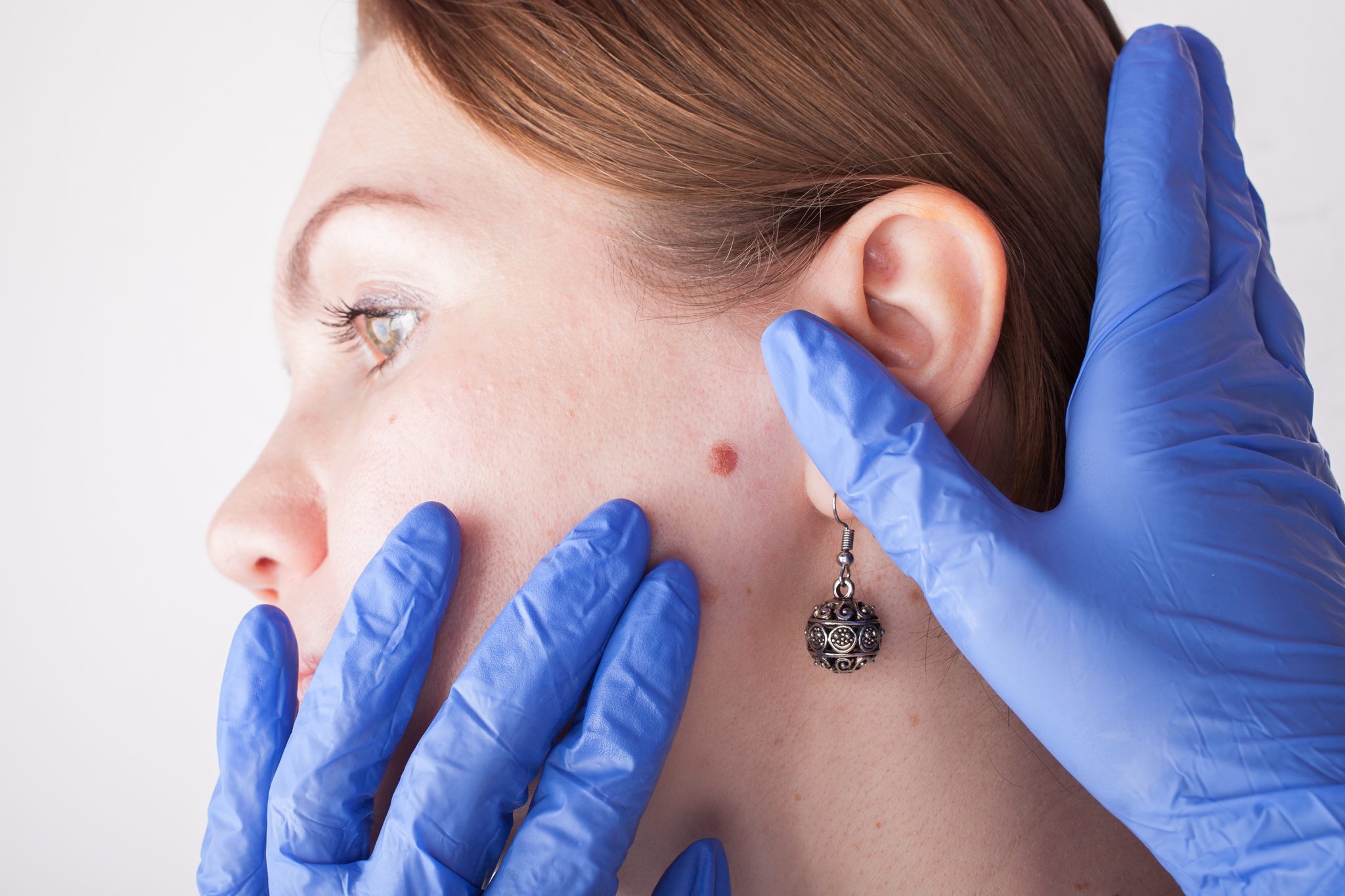 Tratamiento para eliminación de verrugas u otras lesiones de la piel facial