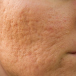 Láser CO2 en cicatrices de acné facial