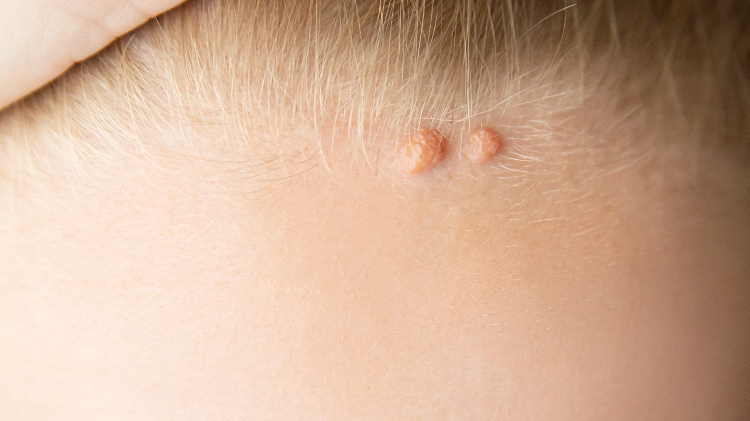 Tratamiento para eliminación de lesiones de la piel del cuero cabelludo
